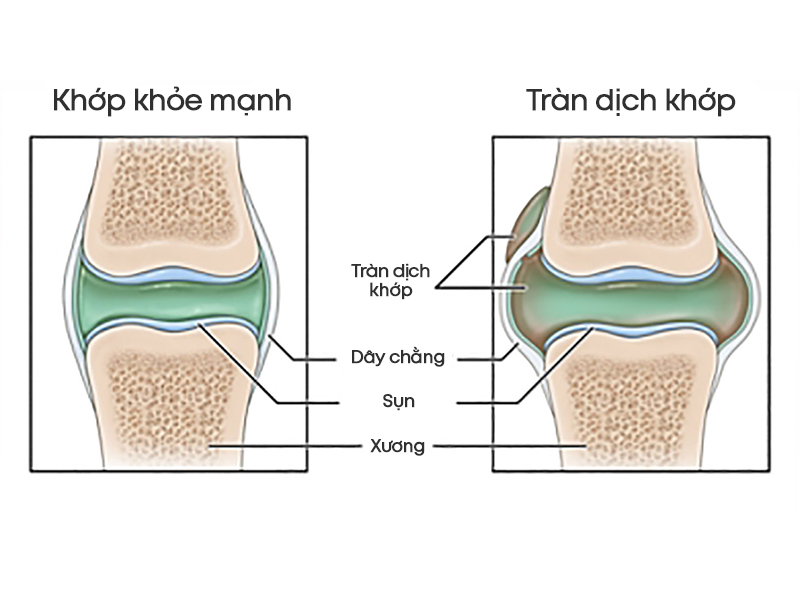 Tràn dịch khớp gối và cách điều trị không dùng thuốc