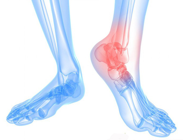 viêm gân gót chân uống thuốc gì thuốc điều trị viêm gân gót chân thuốc chữa viêm gân gót chân